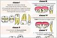 Dentes anteriores lesões de classe III